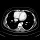 Scimitar syndrome, scimitar sign, anomalous return of pulmonary vein, dextroposition of heart: CT - Computed tomography