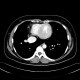 Scimitar syndrome, scimitar sign, anomalous return of pulmonary vein, dextroposition of heart: CT - Computed tomography