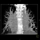 Scimitar syndrome, scimitar sign, anomalous return of pulmonary vein, dextroposition of heart: CT - Computed tomography