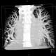 Scimitar syndrome, scimitar sign, anomalous return of pulmonary vein, dextroposition of heart: CT - Computed tomography