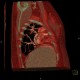 Scimitar syndrome, scimitar sign, anomalous return of pulmonary vein, dextroposition of heart: CT - Computed tomography