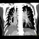 Scimitar syndrome, scimitar sign, anomalous return of pulmonary vein, dextroposition of heart: CT - Computed tomography