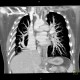 Scimitar syndrome, scimitar sign, anomalous return of pulmonary vein, dextroposition of heart: CT - Computed tomography