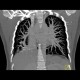 Scimitar syndrome, scimitar sign, anomalous return of pulmonary vein, dextroposition of heart: CT - Computed tomography