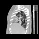 Scimitar syndrome, scimitar sign, anomalous return of pulmonary vein, dextroposition of heart: CT - Computed tomography