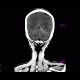 Subdural hematoma on tentorium: CT - Computed tomography