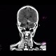 Subdural hematoma on tentorium: CT - Computed tomography