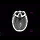 Subdural hematoma on tentorium: CT - Computed tomography