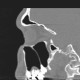 Septum of the left maxillary sinus: CT - Computed tomography