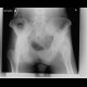 Gluteus minimus, gluteus medius, shadow of muscle: X-ray - Plain radiograph