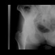 Gluteus minimus, gluteus medius, shadow of muscle: X-ray - Plain radiograph