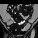 Bowel obstruction, carcinoma of sigmoid colon, SBO, ileus, colorectal cancer: CT - Computed tomography