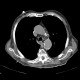Skin folds, mimic of pneumothorax, PNO: CT - Computed tomography
