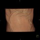 Skin folds, mimic of pneumothorax, PNO: CT - Computed tomography
