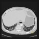 Sclerodermia, pulmonary fibrosis, UIP, fibrosis, oesophagus: CT - Computed tomography