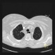 Sclerodermia, pulmonary fibrosis, UIP, fibrosis, oesophagus: CT - Computed tomography