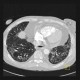 Sclerodermia, pulmonary fibrosis, UIP, fibrosis, oesophagus: CT - Computed tomography