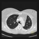 Sclerodermia, pulmonary fibrosis, UIP, fibrosis, oesophagus: CT - Computed tomography