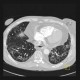Sclerodermia, pulmonary fibrosis, UIP, fibrosis, oesophagus: CT - Computed tomography
