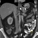 Gastric banding, slipped: CT - Computed tomography