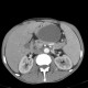 Small cell lung carcinoma, SCLC, metastasis in pancreas, after therapy: CT - Computed tomography