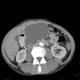 Small cell lung carcinoma, SCLC, metastasis in pancreas, after therapy: CT - Computed tomography