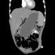 Small cell lung carcinoma, SCLC, metastasis in pancreas, after therapy: CT - Computed tomography