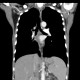 Small cell lung carcinoma, SCLC, metastasis in pancreas, after therapy: CT - Computed tomography