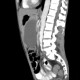 Small cell lung carcinoma, SCLC, metastasis in pancreas, after therapy: CT - Computed tomography