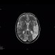 SLE, systemic lupus erythematodes, cerebral ischemia: MRI - Magnetic Resonance Imaging