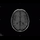 SLE, systemic lupus erythematodes, cerebral ischemia: MRI - Magnetic Resonance Imaging