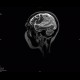 SLE, systemic lupus erythematodes, cerebral ischemia: MRI - Magnetic Resonance Imaging