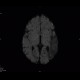 SLE, systemic lupus erythematodes, cerebral ischemia: MRI - Magnetic Resonance Imaging