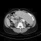 Splenomegally in lymphoma: CT - Computed tomography