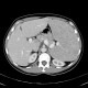 Splenomegally, lymphoma: CT - Computed tomography