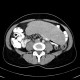 Splenomegally, lymphoma: CT - Computed tomography