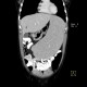 Splenomegally, lymphoma: CT - Computed tomography