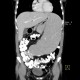 Splenomegally, lymphoma: CT - Computed tomography