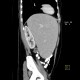 Splenomegally, lymphoma: CT - Computed tomography