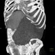 Splenomegally, lymphoma: CT - Computed tomography