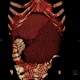 Splenomegally, lymphoma: CT - Computed tomography