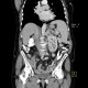 Splenorenal collaterals, shunting: CT - Computed tomography