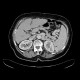 Splenorenal collaterals, shunting: CT - Computed tomography