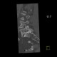 Spondylolisthesis, spondylolysis, lumbar vertebra: CT - Computed tomography