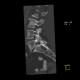 Spondylolisthesis, spondylolysis, lumbar vertebra: CT - Computed tomography