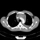 Stab wound of the thorax, perforation of the ascending aorta, bleeding into mediastinum, hemothorax: CT - Computed tomography