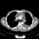 Stab wound of the thorax, perforation of the ascending aorta, bleeding into mediastinum, hemothorax: CT - Computed tomography