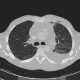 Stab wound of the thorax, perforation of the ascending aorta, bleeding into mediastinum, hemothorax: CT - Computed tomography