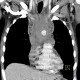Stab wound of the thorax, perforation of the ascending aorta, bleeding into mediastinum, hemothorax: CT - Computed tomography