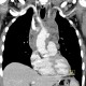 Stab wound of the thorax, perforation of the ascending aorta, bleeding into mediastinum, hemothorax: CT - Computed tomography